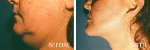 liposuction faq before and after lipo double chin