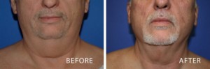 before and after liposuction chin