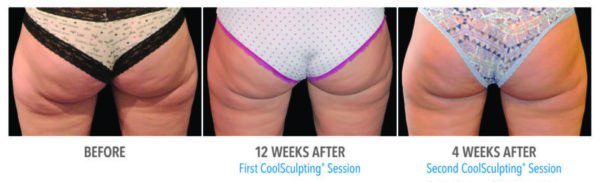 coolsculpting results