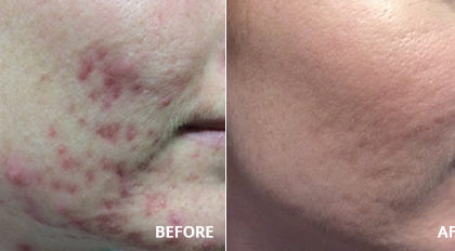 Acne Treated With Accutane Laser And Skin Surgery Center Of Indiana