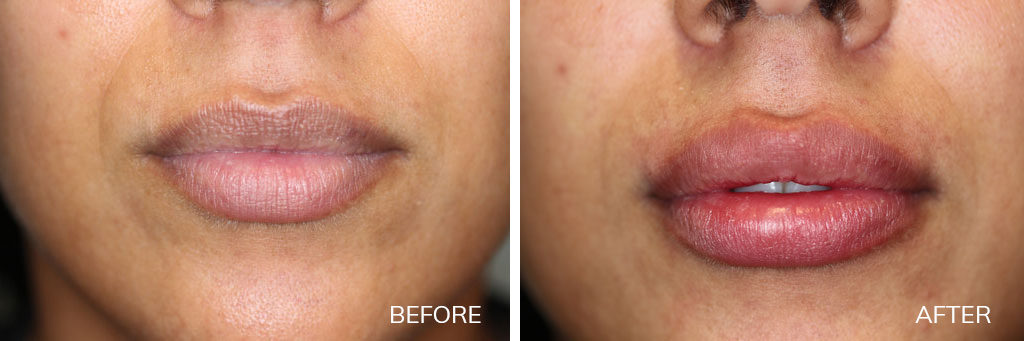 Cosmetic Fillers Archives - Laser and Skin Surgery Center of Indiana