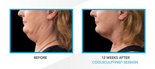 coolsculpting double chin results