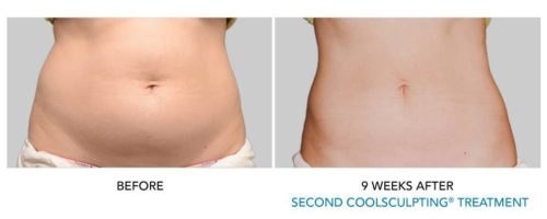 coolsculpting belly fat results