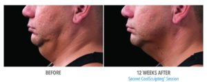 coolsculpting for men double chin reduction