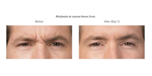 botox for frown lines