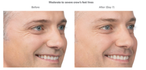 botox for crows feet