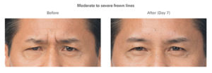 botox for men before and after