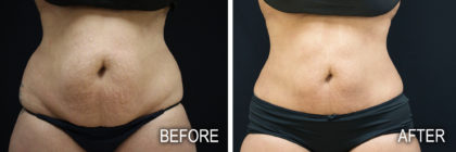 coolsculpting before and after photos