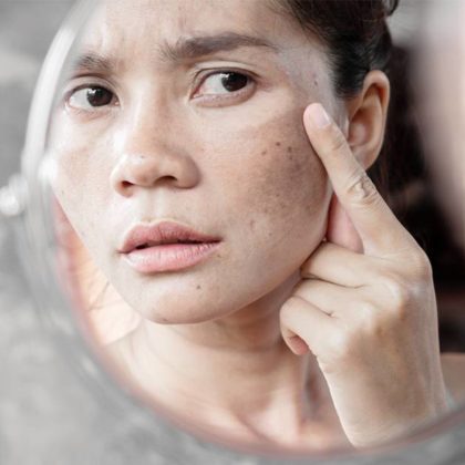 hyperpigmentation and melasma indianapolis