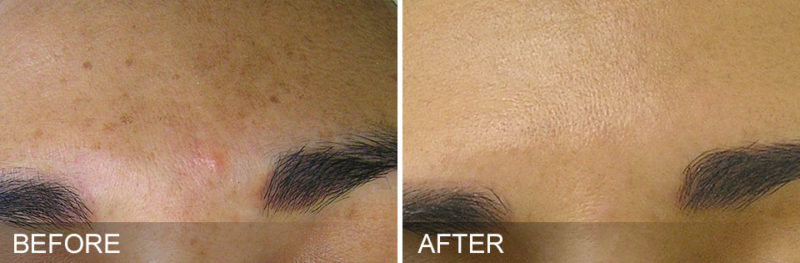 hydrafacial for brown spots