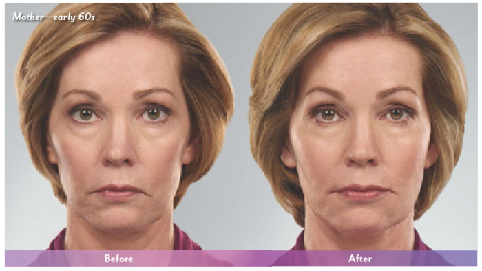 juvederm liquid facelift results