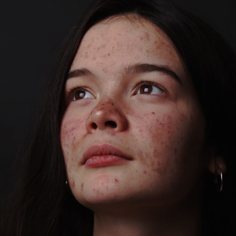 cystic acne