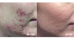 acne before and after accutane