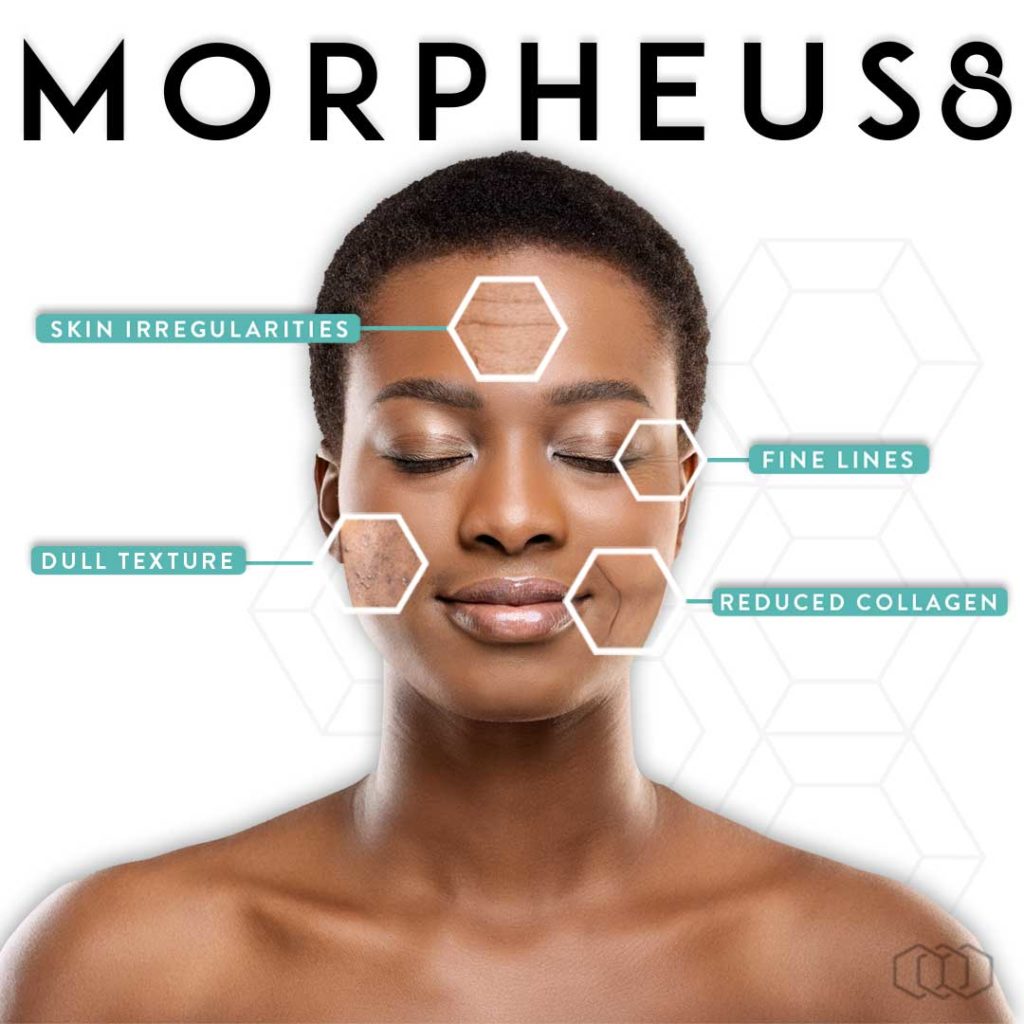 morpheus8 treatment benefits