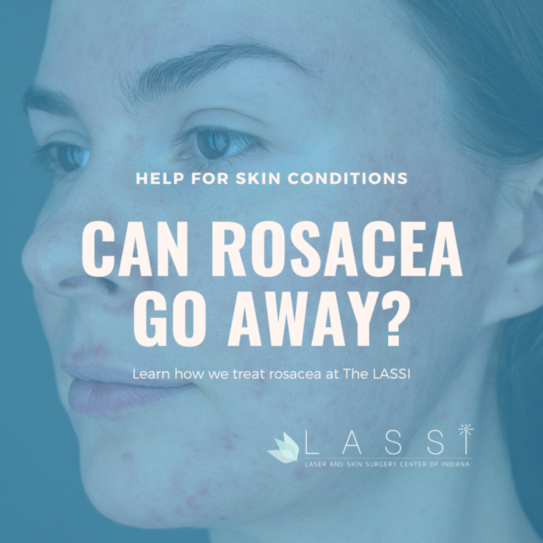 can rosacea go away