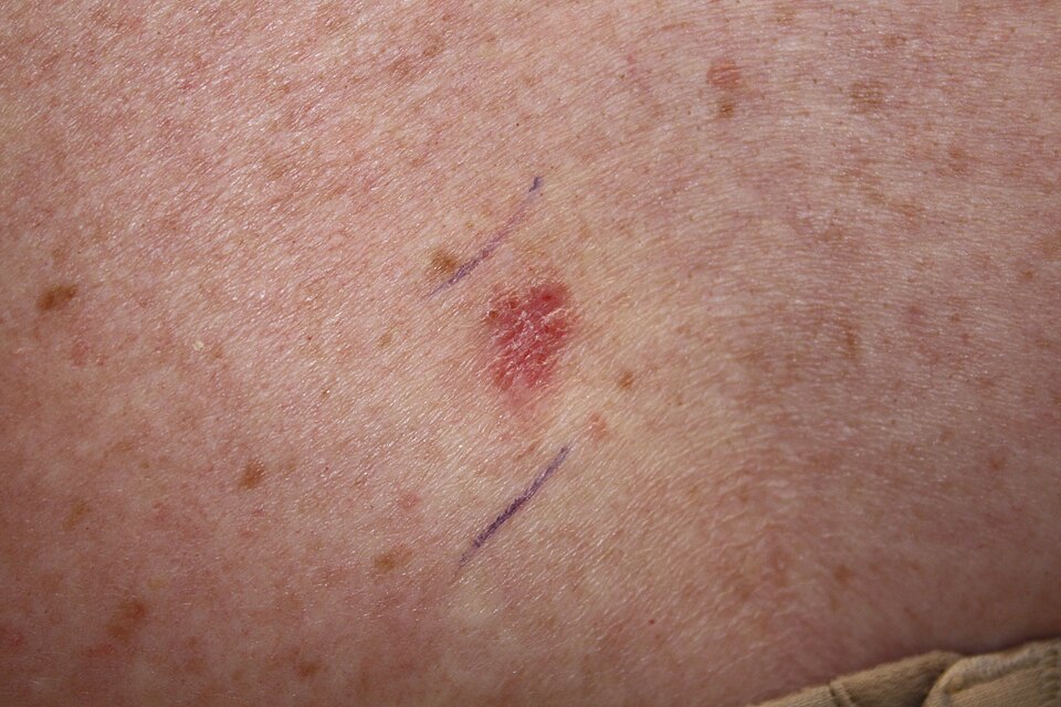 basal cell carcinoma skin cancer