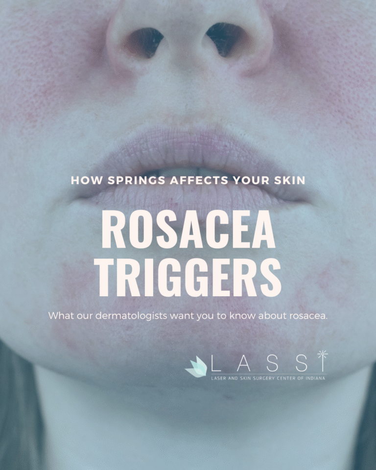 photo of a woman with rosacea with Rosacea Triggers in big letters to learn about spring rosacea causes